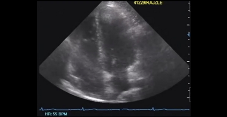 ECG (Electrocardiography)