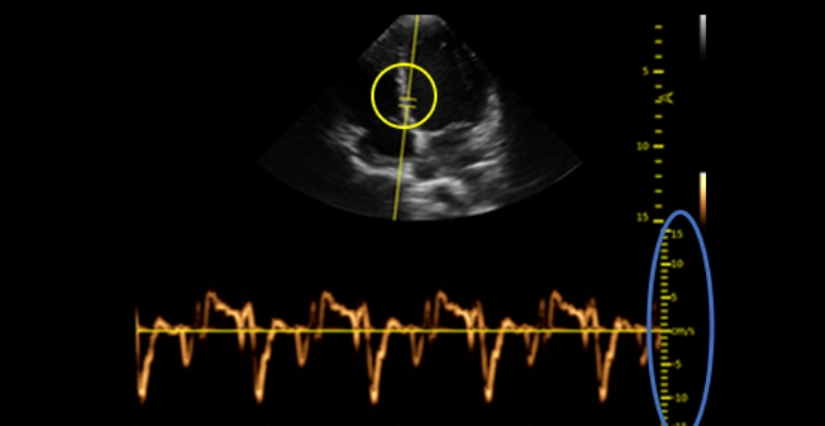 TD (Tissue Doppler)_TD