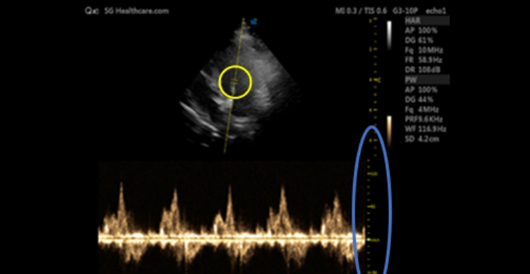 TD (Tissue Doppler)_PW